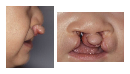 口唇裂 口の変形 生まれつきの病気 形成外科で扱う疾患 一般の方へ 一般社団法人 日本形成外科学会