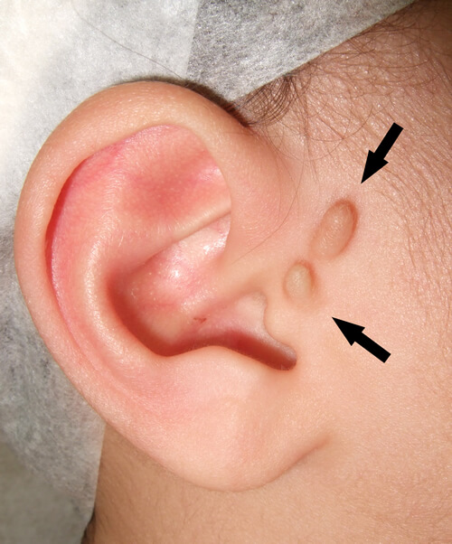 副耳 耳の変形 生まれつきの病気 形成外科で扱う疾患 一般の方へ 一般社団法人 日本形成外科学会