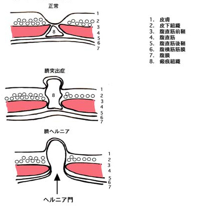臍突出症 臍ヘルニア 腹部 生まれつきの病気 形成外科で扱う疾患 一般の方へ 一般社団法人 日本形成外科学会
