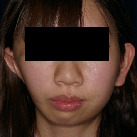 第一第二鰓弓症候群（ヘミフェイシャルマイクロソミア）｜日本形成外科学会