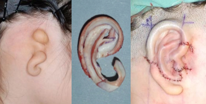 小耳症 耳の変形 生まれつきの病気 形成外科で扱う疾患 一般の方へ 一般社団法人 日本形成外科学会