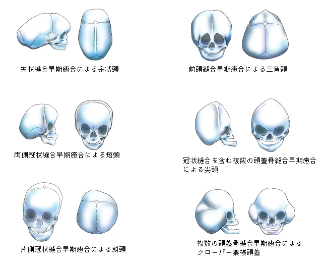 頭蓋縫合早期癒合症 頭の骨の変形 生まれつきの病気 形成外科で扱う疾患 一般の方へ 一般社団法人 日本形成外科学会