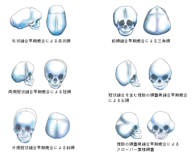 頭蓋縫合早期癒合症 日本形成外科学会