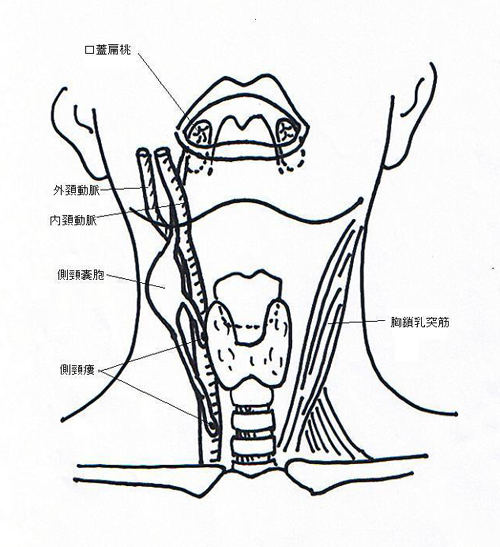 側頚嚢胞 首 生まれつきの病気 形成外科で扱う疾患 一般の方へ 一般社団法人 日本形成外科学会