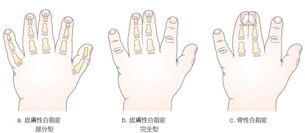 手の先天異常 発生機序から臨床像,治療まで - 健康/医学