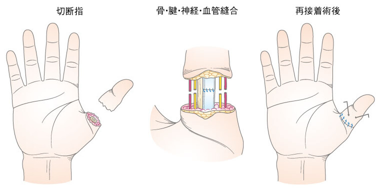 切断指 けが 外傷 けが きずあと 形成外科で扱う疾患 一般の方へ 一般社団法人 日本形成外科学会
