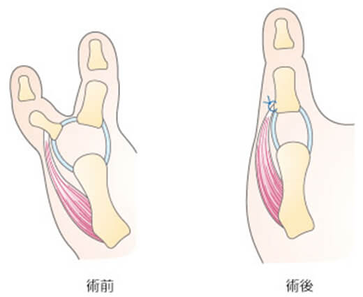 多指症｜日本形成外科学会