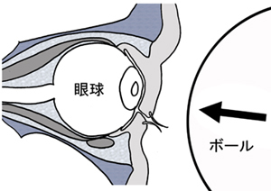 眼窩底骨折 日本形成外科学会