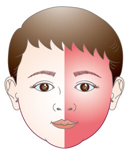 母斑症 皮膚 生まれつきの病気 形成外科で扱う疾患 一般の方へ 一般社団法人 日本形成外科学会