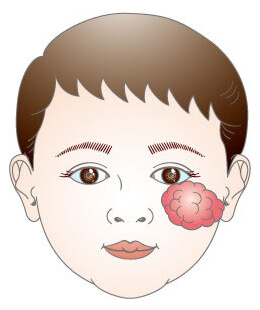 血管腫 血管奇形 皮膚 生まれつきの病気 形成外科で扱う疾患 一般の方へ 一般社団法人 日本形成外科学会
