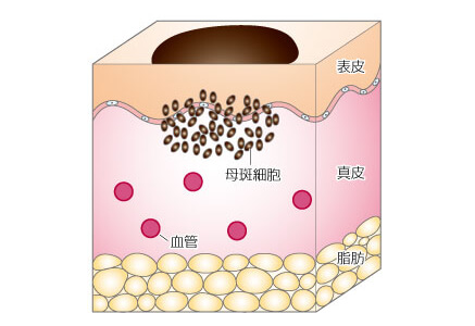 色素性母斑 皮膚 生まれつきの病気 形成外科で扱う疾患 一般の方へ 一般社団法人 日本形成外科学会