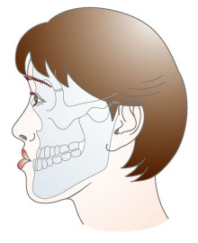 顎変形症 その他 形成外科で扱う疾患 一般の方へ 一般社団法人 日本形成外科学会