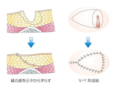 毛巣洞 爪 毛などの疾患 その他 形成外科で扱う疾患 一般の方へ 一般社団法人 日本形成外科学会