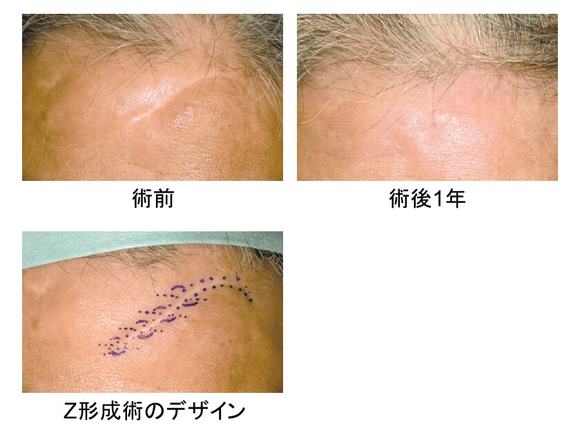 傷跡をケアし、傷跡を最小限に抑える方法